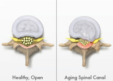 Vertos Raises $26M To Treat Back Pain
