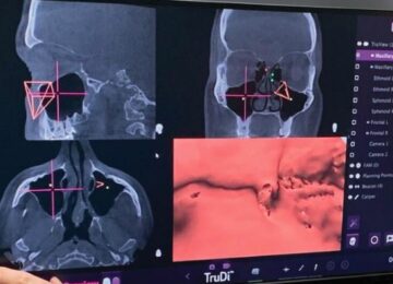 Irvine’s Acclarent Being Sold for $275M