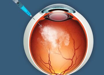 JCyte Launches Phase 2 Study to Treat Rare Eye Disease