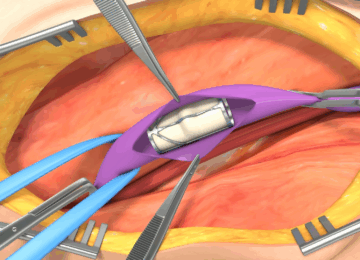 enVVeno Medical Shares Plunge 79% on FDA Denial