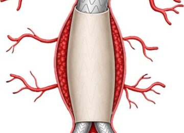 Bill Colone Launches Startup to Improve Aneurysm Repair